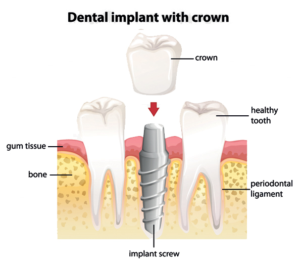 Diagram of the structure of a dental implant